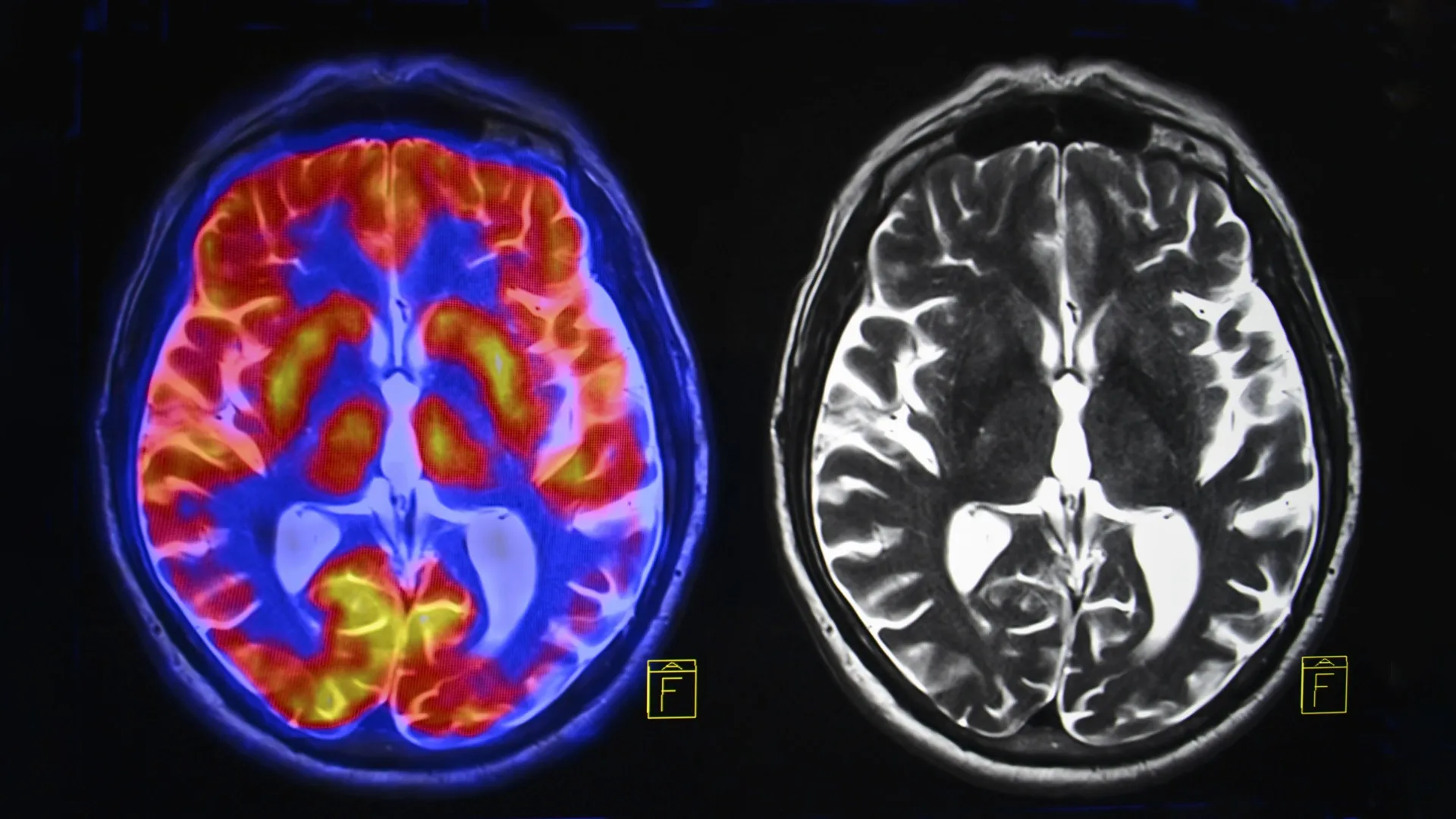 Esquema conceptual de conexiones entre regiones cerebrales para ilustrar patrones distintos de conectividad en autismo